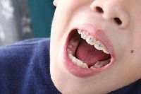 【健康解碼】矯正牙齒真的可以瘦臉嗎？